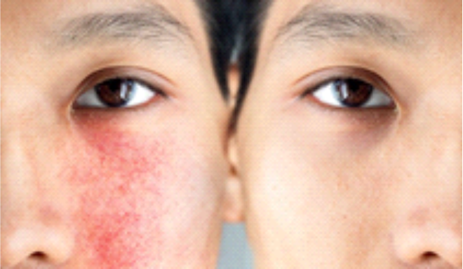 Gambar Kulit sensitif