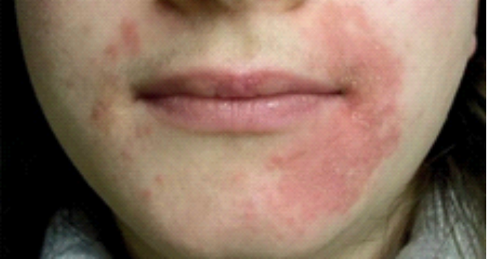 Gambar Kulit sensitif