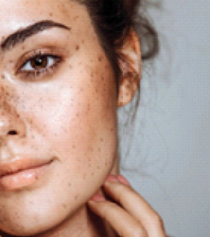 Gambar Kulit Berminyak Hingga Berjerawat