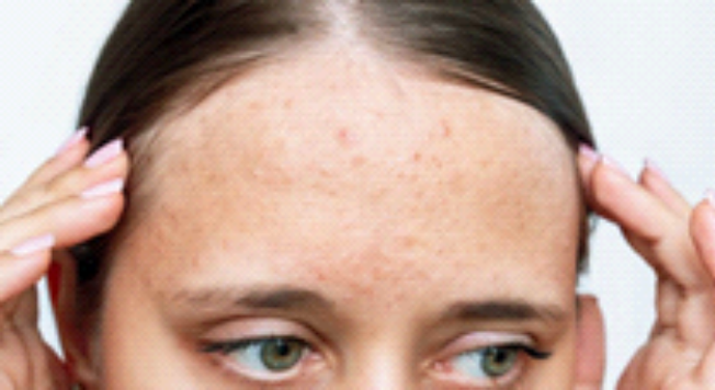 Gambar Kulit Berminyak Hingga Berjerawat