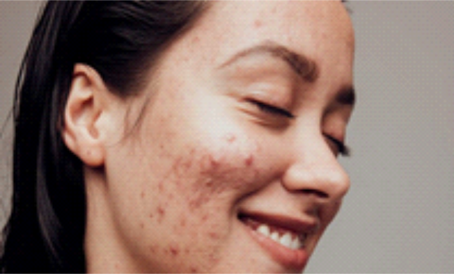 Gambar Kulit Berminyak Hingga Berjerawat