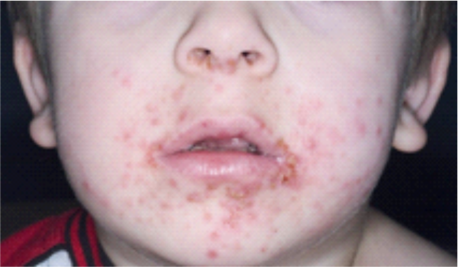 Gambar Kulit sensitif