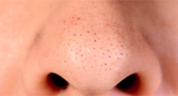 Gambar Kulit Berminyak Hingga Berjerawat